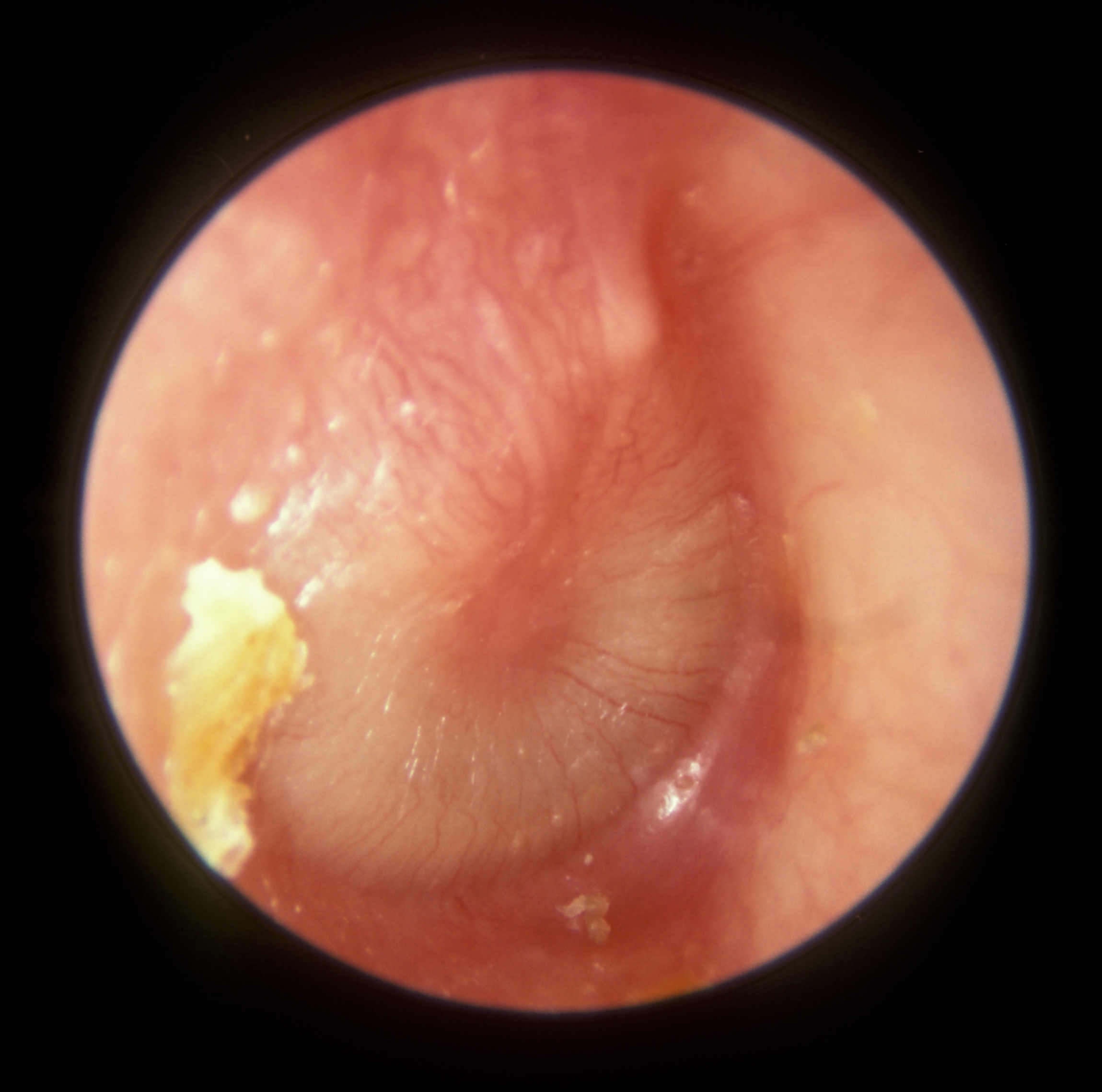 otitis media