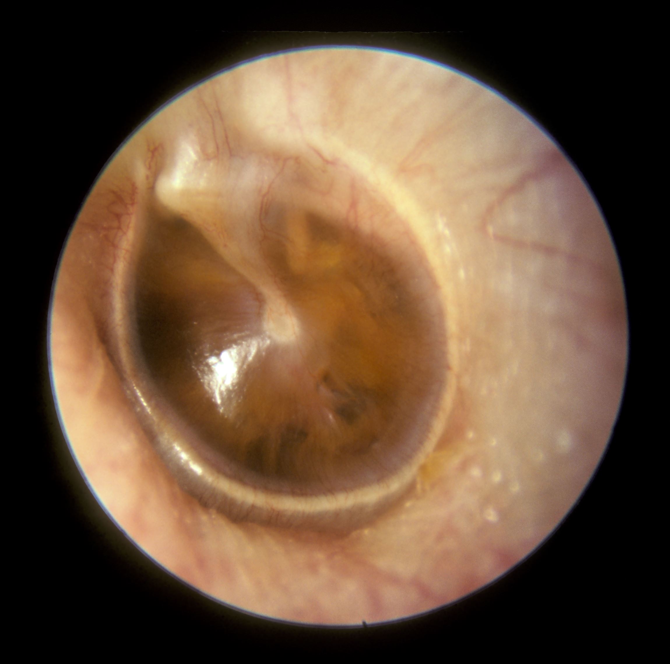 otitis media