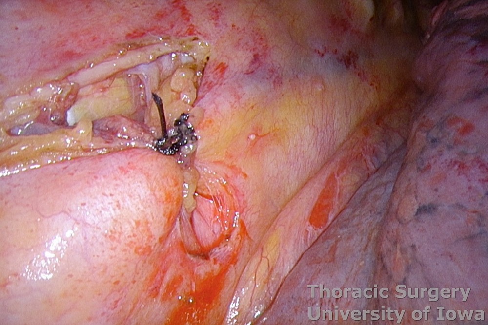 Thoracic duct ligation | Iowa Head and Neck Protocols