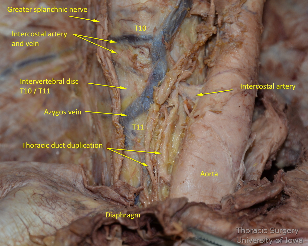 Anatomic dissection of the partial proximal duplication of the thoracic duct