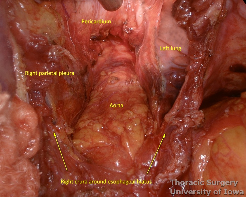 exposure of the posterior mediastinum during esophagectomy  dissection and hemostasis check