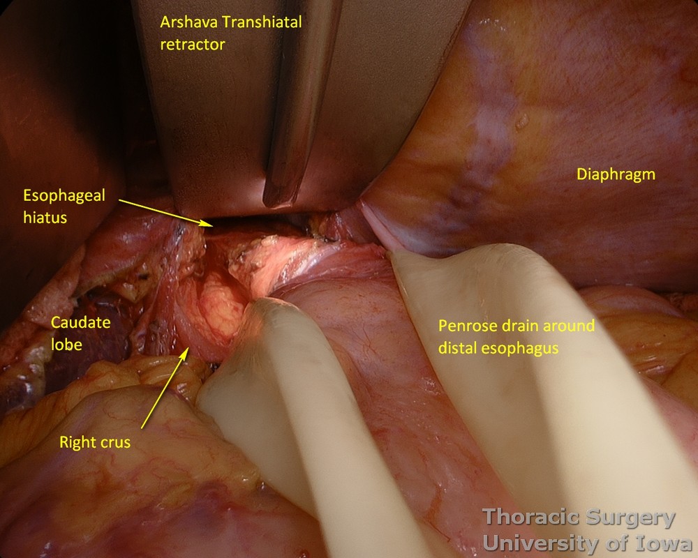 illuminated transhiatal retractor is used to facilitate exposure for mediastinal dissection during esophagectomy