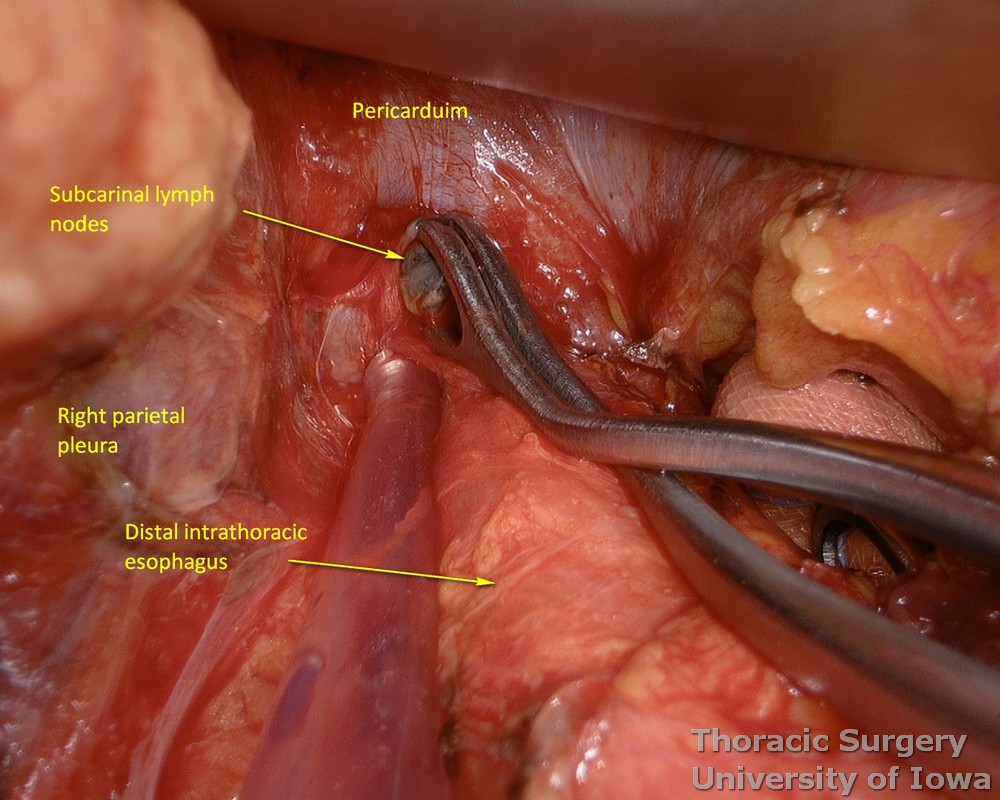 Subcarinal lymph nodes are resected during esophagectomy with limited uses of energy devices