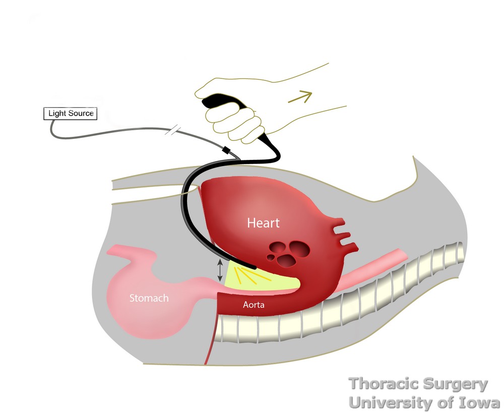 Arshava transhiatal retractor designed for comfortable retraction and improved visualization in the posterior mediastinum during esophagectomy