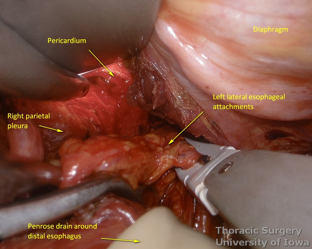 Division of left lateral esophageal attachments during transhiatal esophagectomy