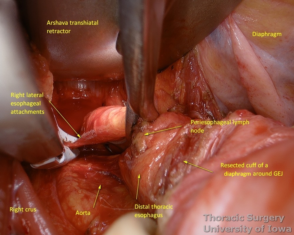 Right lateral esophageal attachments are divided during transhiatal esophagectomy under direct vision