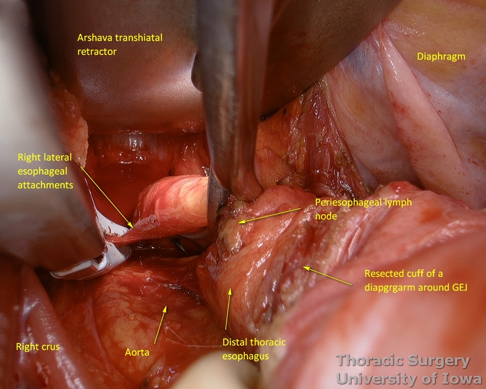 Division of right lateral esophageal attachments during transhiatal esophagectomy