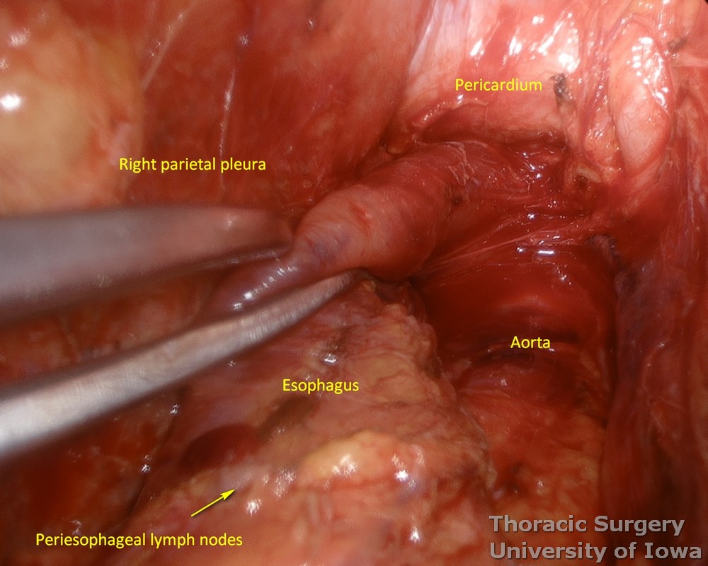 mediastinal dissection during esophagectomy with thoracic esophagus retracted and aorta exposed