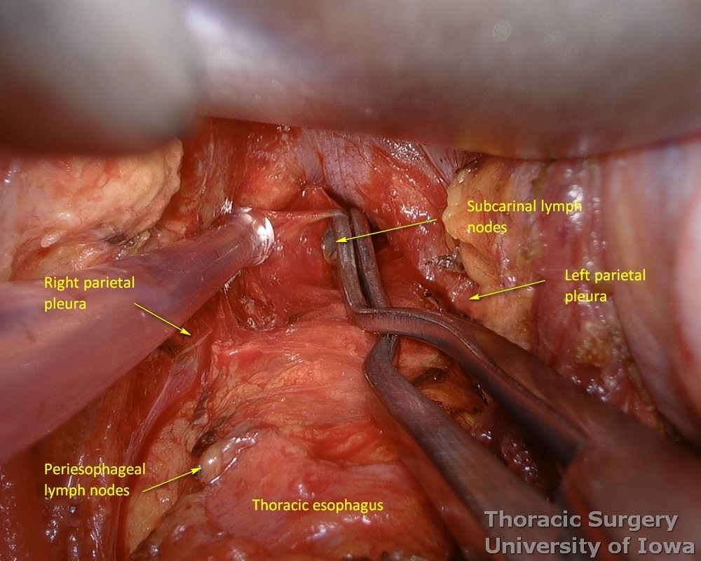  subcarinal lymph nodes are resected during esophagectomy under direct vision