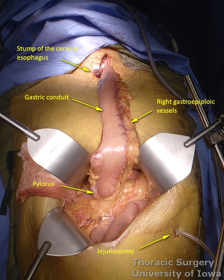 At the completion of the transhiatal phase gastric conduit easily reaches the cervical incision