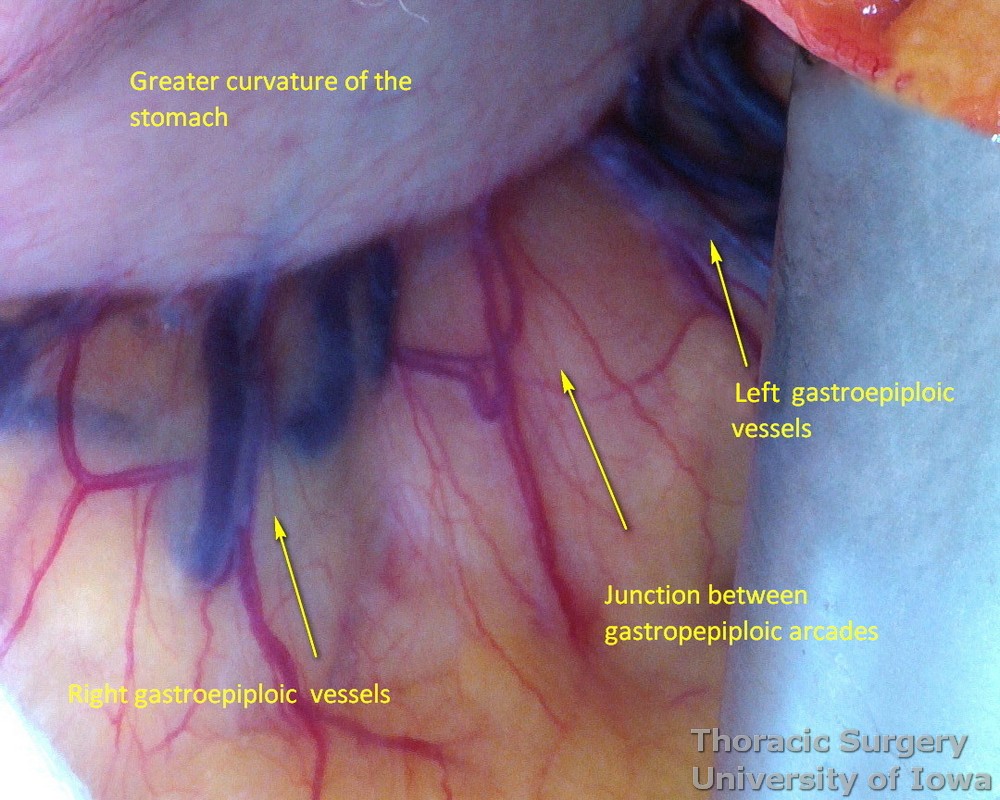 Avascular area on greater curvature of the stomach between right and left  gastroepiploic arcades.jpg