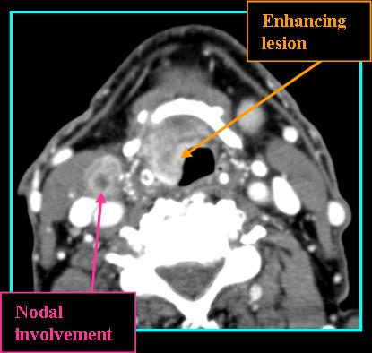 lingual tonsil cancer symptoms