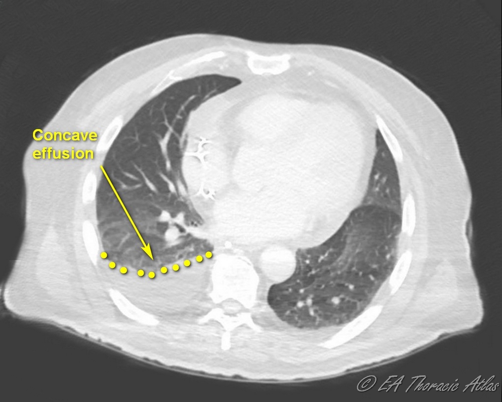 Concave shaped line suggesting free floating pleural effusion