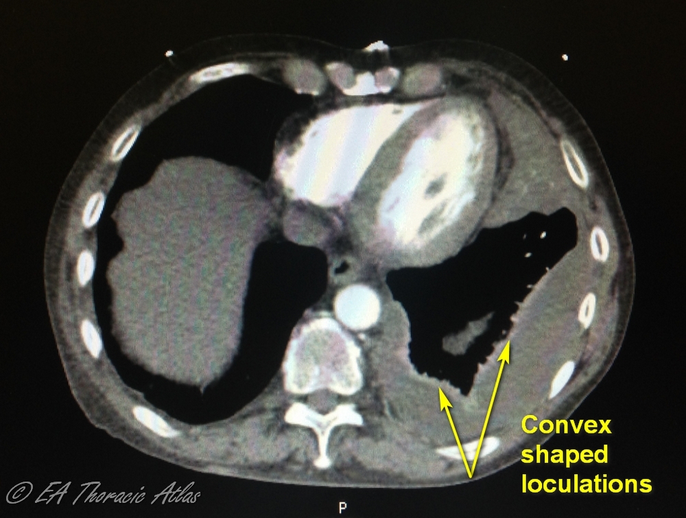 Convex shaped pleural loculations indicates high density fluid and debris