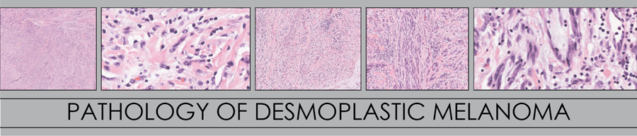 malignant melanoma histology