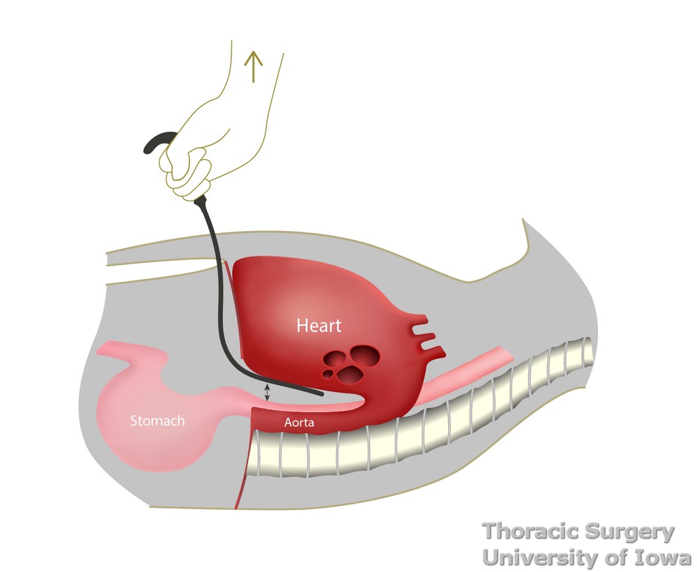 Deaver retractor provides very limited visualization of the mediastinum during transhiatal esophagectomy