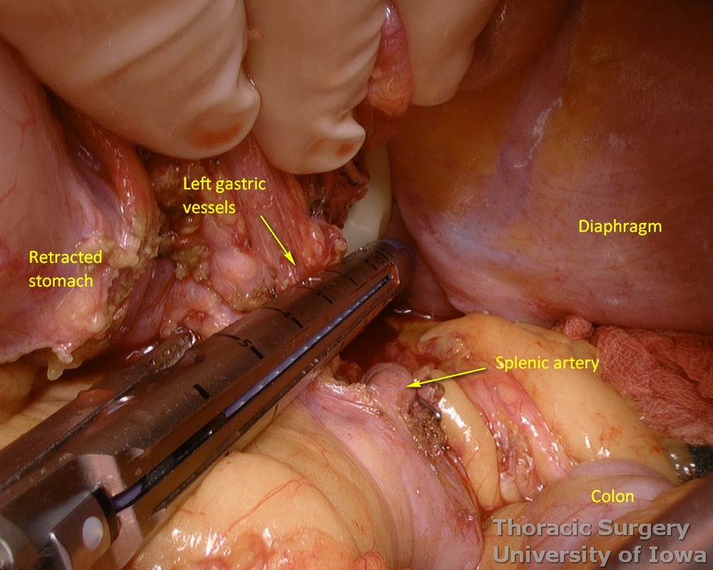 Division of the left gastric vessels with inclusion of lymph nodes into the specimen during esophagectomy