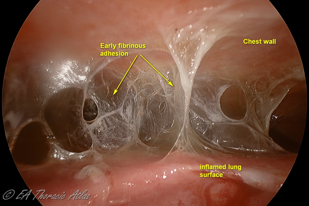 Early fibrinous pleural adhesions 