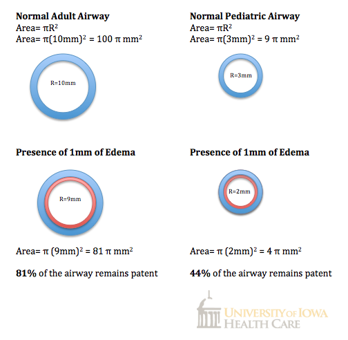 Edema and Airway Size