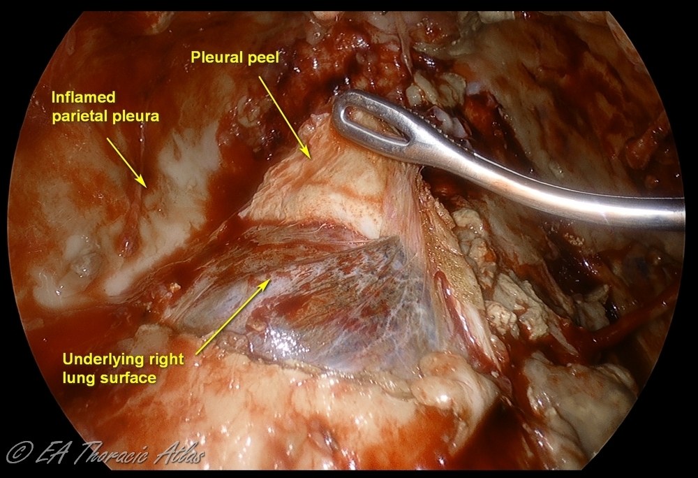 Empyema early Stage III (fibrous phase) with thick rind covering lung and preventing its reexpansion