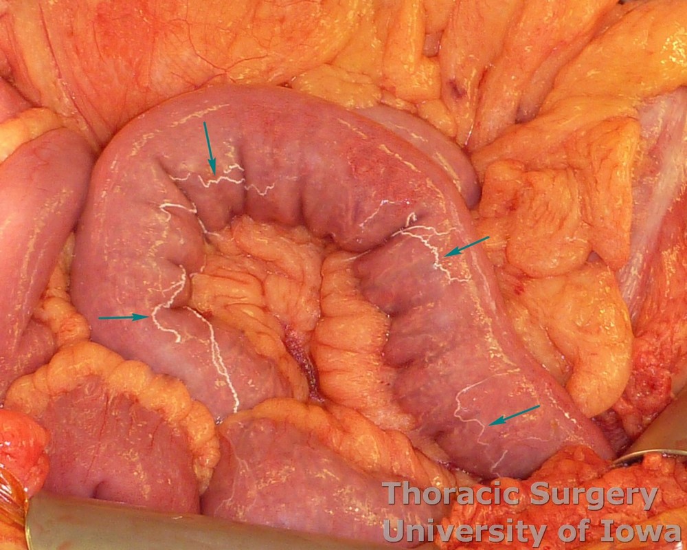 Engorged lymphatic vessels of small intestines of nonfasting trauma patient_annotated