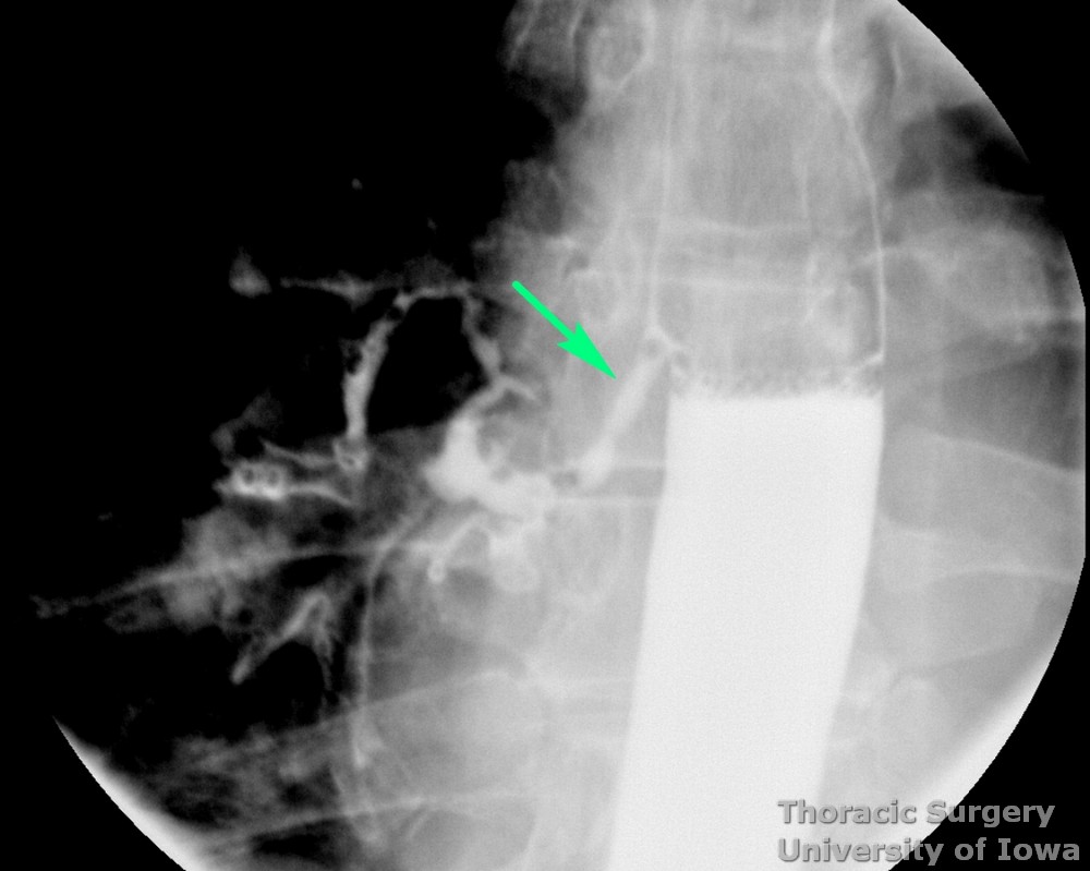 Esophagram  demonstrates erosion of the midesophageal traction diverticulum resulting in an esophagobronchial fistula