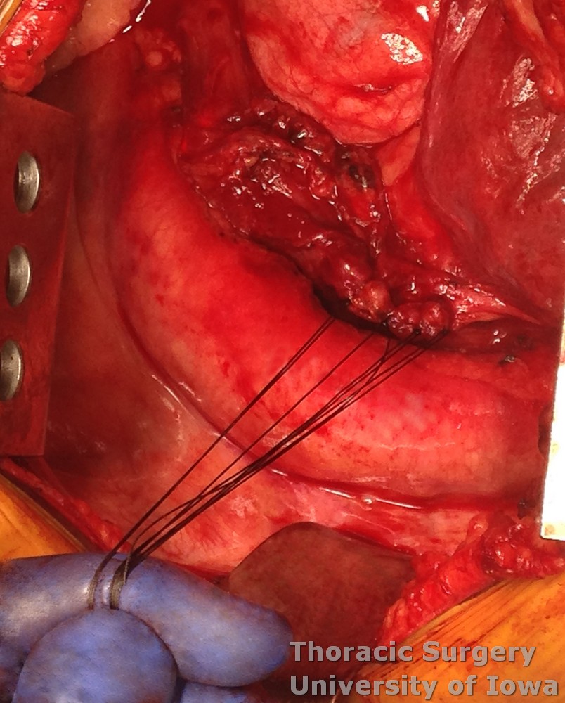Esophageal diverticulum   muscle layer  is approximated over the diverticulectomy site with absorbable interrupted stitches.jpg