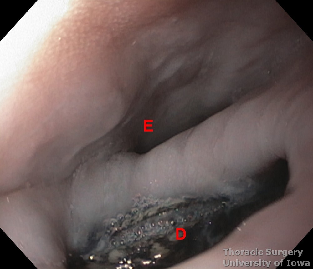 Esophageal diverticula  Endoscopy with Esophageal lumen and entrance into Diverticulum with retained food