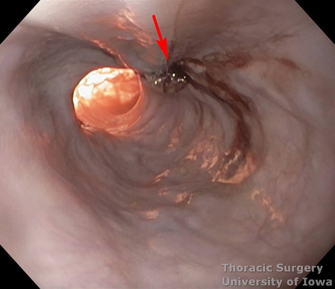 Esophageal diverticula midesophageal  and epiphrenic  Intraoperative endoscopy diverticulectomy site and distal myotomy