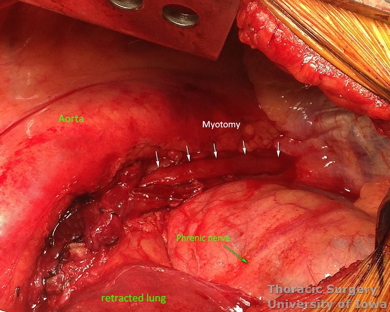 Esophageal diverticula midesophageal  and epiphrenic  extent of myotomy after diverticulectomy chest anatomy demonstrated