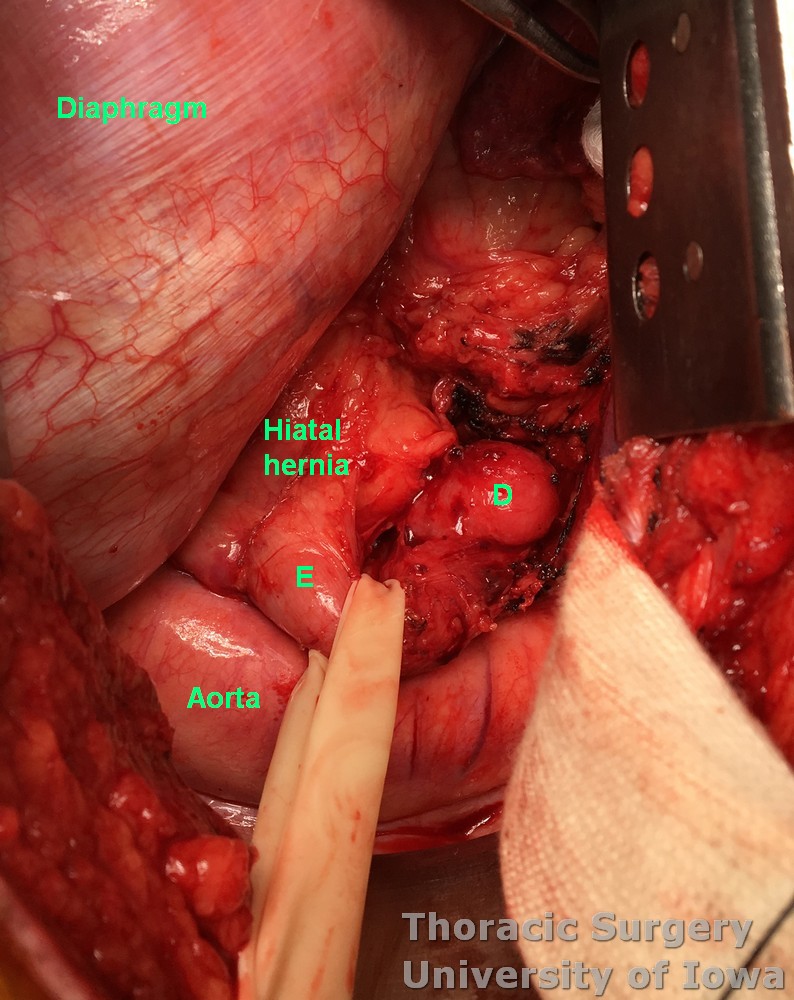 Esophageal diverticula midesophageal  and epiphrenic dissection with esophagus retracted  and chest anatomy demonstrated