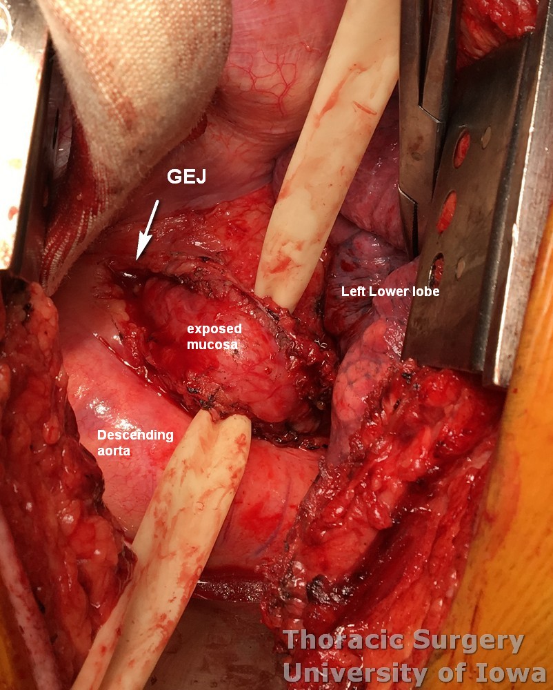Esophageal diverticulum  myotomy to gastroesophageal junction completed intact underlying mucosa  chest anatomy