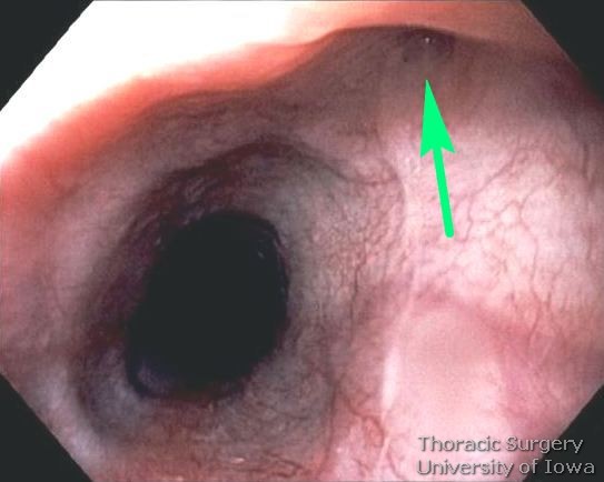Flexible endoscopy demonstrating Esophageal traction diverticulum midesophageal  secondary to Histoplasmosis mediastinal granuloma complicated perforated resulting in mediastinitis