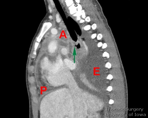 Esophageal traction diverticulum midesophageal  complicated perforated with mediastinitis and pericarditis Chest CT