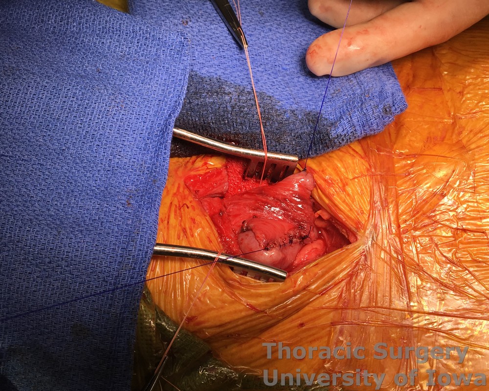 Esophagectomy Opposite sutures are tied in the middle to complete the running inner full thickness layer of the cervical gastro esophageal anastomosis