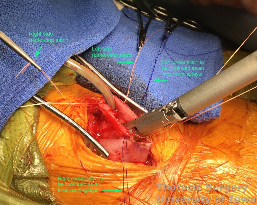 Before the stapler is fired to create the posterior wall of the anastomosis, the seromuscular side stitches additionally secure the conduit to the esophagus and the full-thickness corners stitches are placed for the inner running layer of the anterior wal