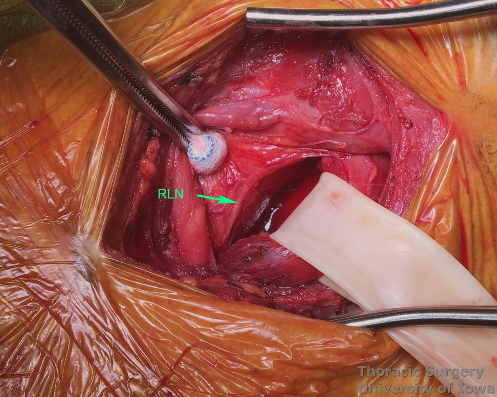 Esophagectomy for esophageal carcinoma cervical gastro esophageal anastomosis Care is taken to protect the recurrent laryngeal nerve