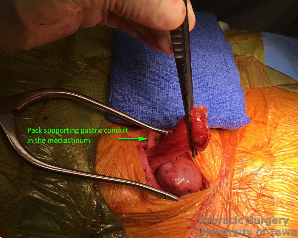 Esophagectomy for esophageal carcinoma cervical gastro esophageal anastomosis Cervical esophagus and tip of the gastric  conduit are aligned