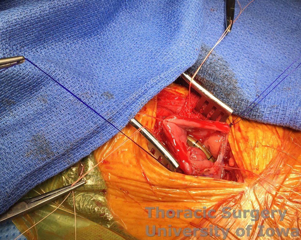 Esophagectomy for esophageal carcinoma cervical gastro esophageal anastomosis Nasogastric tube is advanced through the anastomosis  and positioned near pylorus