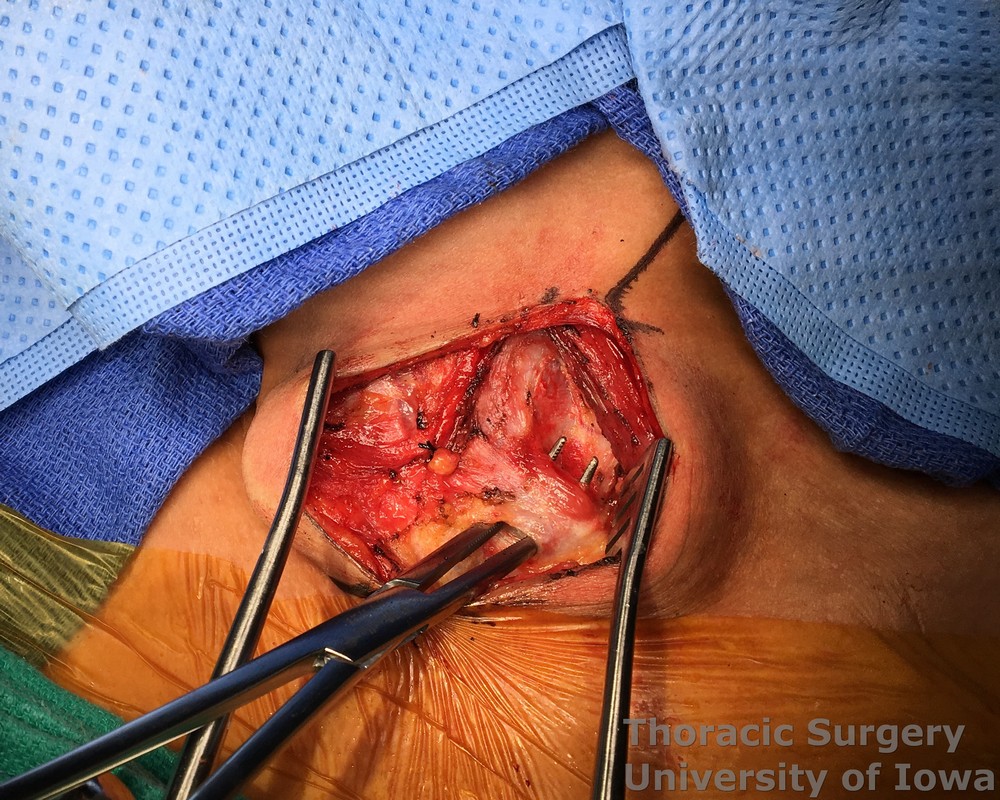 Esophagectomy for esophageal carcinoma cervical gastroesophageal anastomosis Omohyoid muscle is dissected and divided