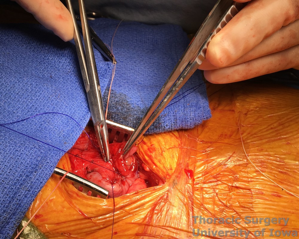 Esophagectomy for esophageal carcinoma cervical gastro esophageal anastomosis Running full thickness inner layer is started from each corner to meet in  the middle