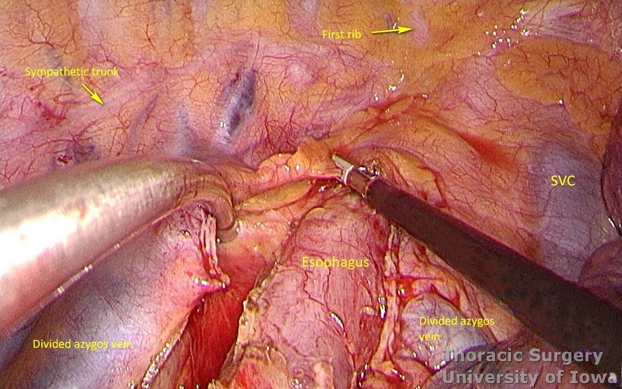 McKeown azygos vein divided esophagus dissection into thoracic outlet