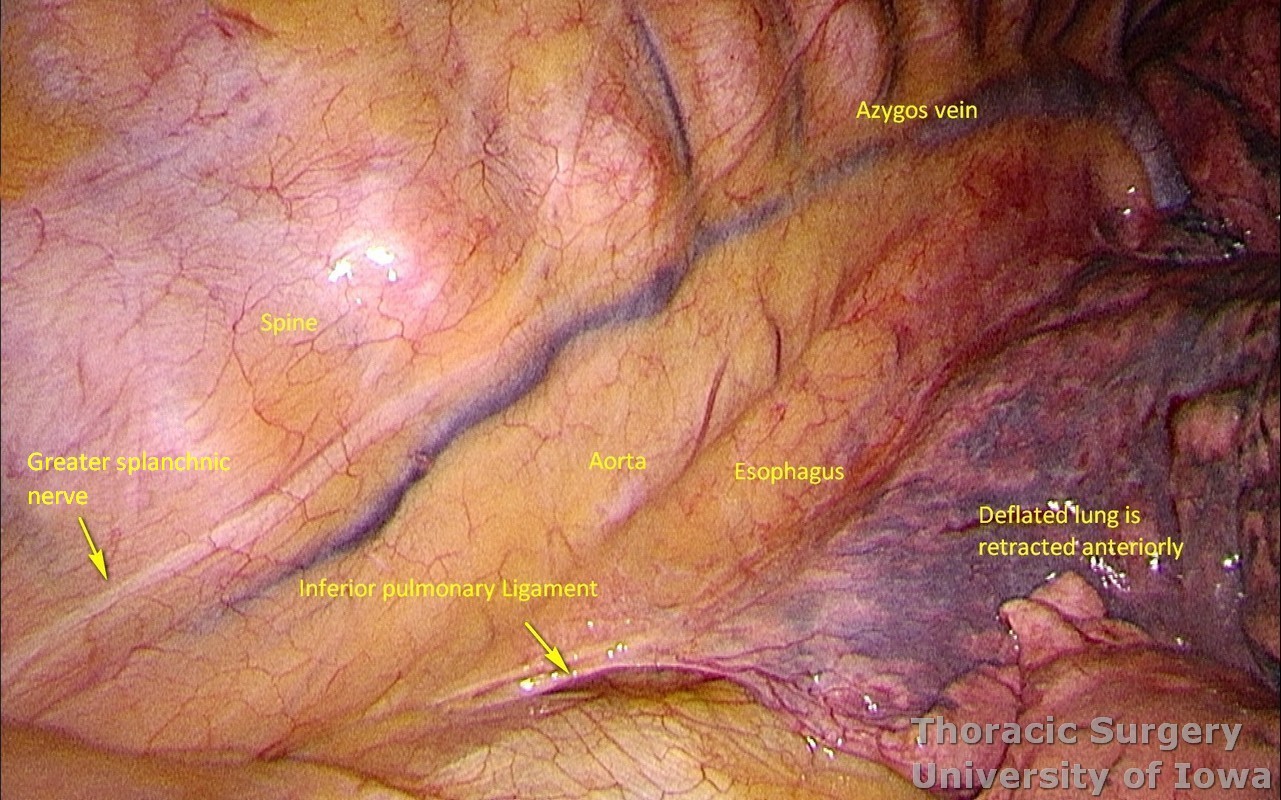 Esophagectomy thoracoscopy for esophageal carcinoma thoracoscopic three incisions McKeown chest anatomy inferior pulmonary ligament
