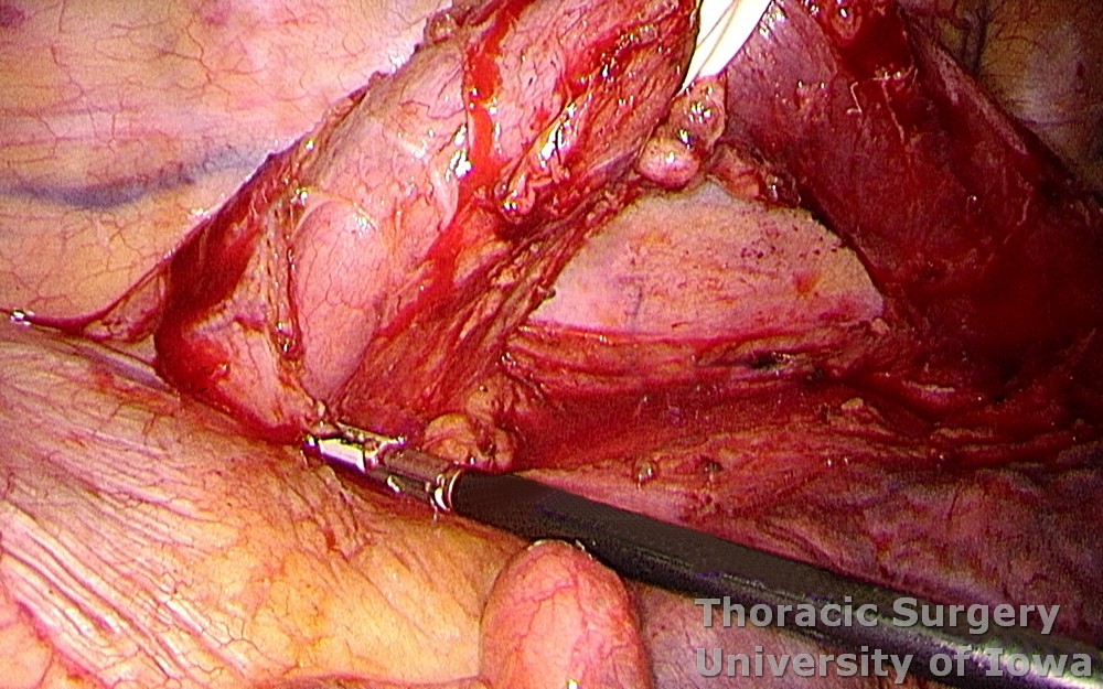 Esophagectomy for esophageal carcinoma thoracoscopic three incisions McKeown esophagus circumferentially dissected caudad to the diaphragmatic hiatus