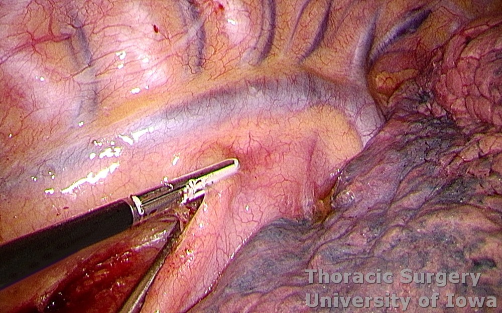 Esophagectomy for esophageal carcinoma thoracoscopic three incisions McKeown esophagus dissected and retracted  parietal pleura incised along the azygos vein cephalad
