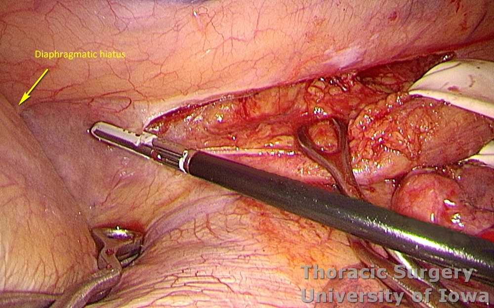 esophagus dissected and retracted  parietal pleura incised towards hiatus
