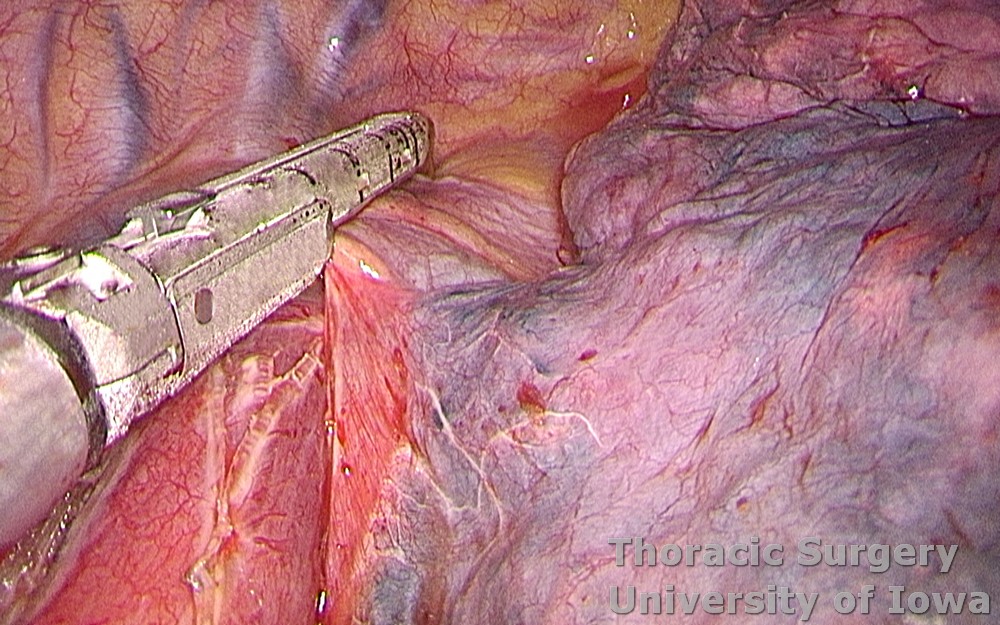 Esophagectomy for esophageal carcinoma thoracoscopic three incisions McKeown esophagus dissected azygos vein divided with the stapler above the esophagus