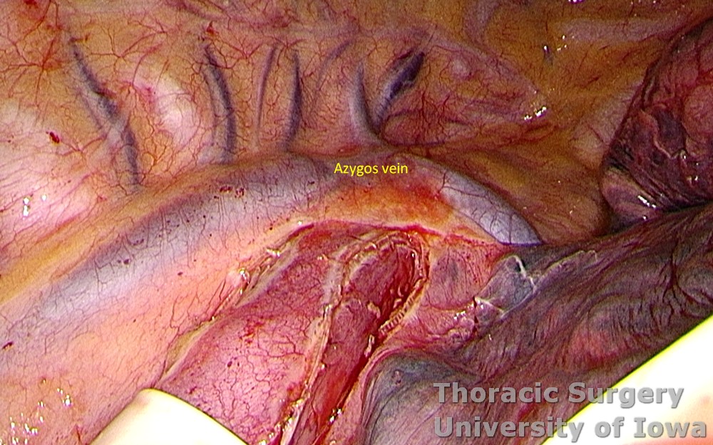 Esophagectomy for esophageal carcinoma thoracoscopic three incisions McKeown esophagus dissected parietal pleura opened above esophagus to the azygos vein