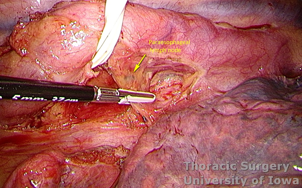 Esophagectomy for esophageal carcinoma thoracoscopic three incisions McKeown esophagus retracted  paraesophageal lymph resected as part of lymphadenectomy