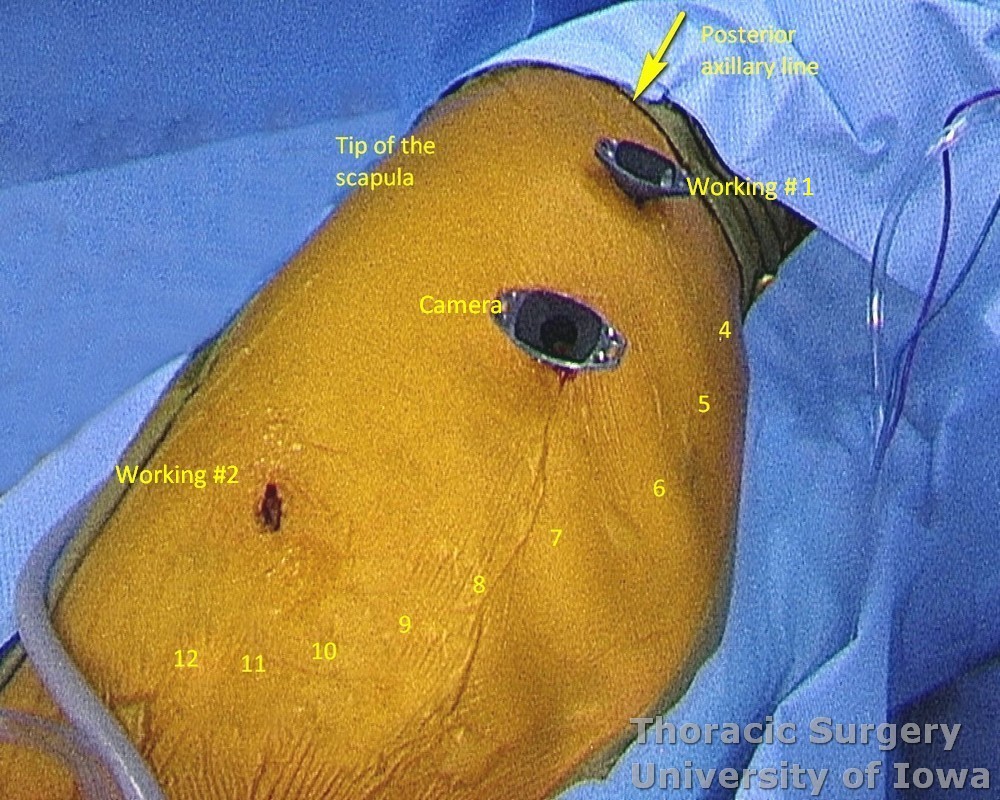 Location of thoracoscopic incisions for a Three-Incision (McKeown)  esophagectomy. Ribs are numbered. 